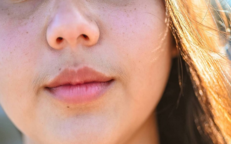 hirsutism in women